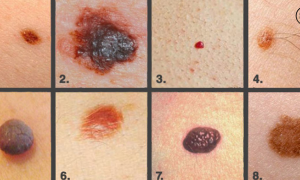 Как выглядит плоскоклеточный рак кожи? фото и описание