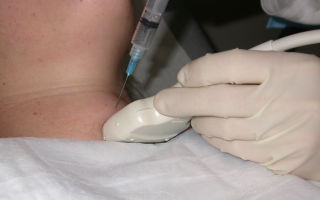 Биопсия щитовидной железы при раке