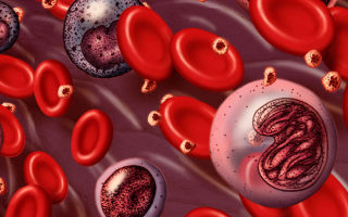 Опухоль крови – инновационное лечение