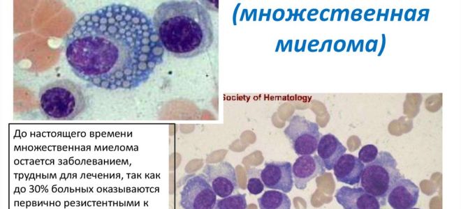 Как добиться ремиссии при миеломе?