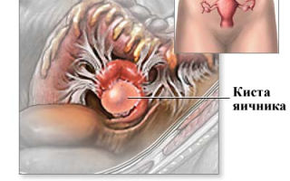 Параовариальная киста яичника: фото, последствия, прогноз