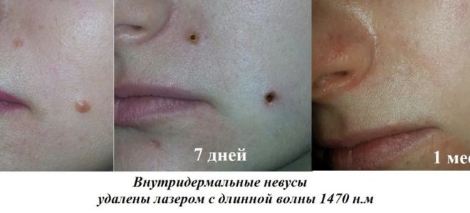 Удаление родинок на лице: последствия