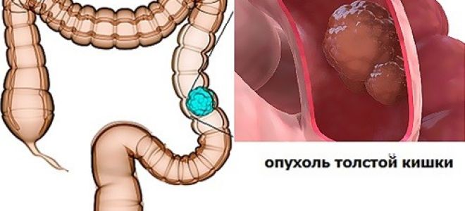 Неполипозный рак толстой кишки: описание, лечение и прогноз