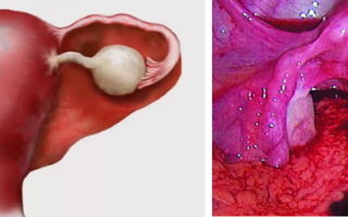 Геморрагическая киста яичника. последствия для женщин
