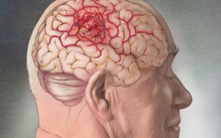 Опухоль в голове: признаки развития, удаление и прогноз