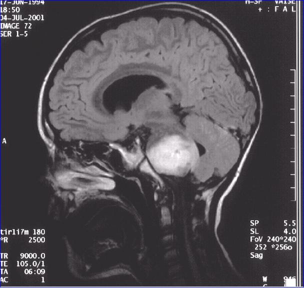 Глиома головного ствола. Диффузная опухоль ствола головного мозга. Опухоли ствола мозга мрт. Глиома мозгового ствола. Опухоль продолговатого мозга мрт.
